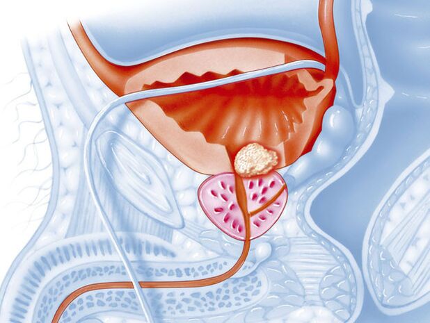 A forma bacteriana de prostatite